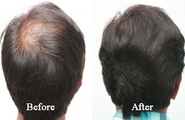 Hair Fall Treatment